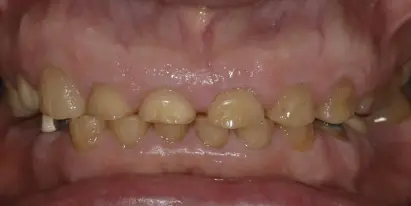 Crowded upper front teeth before orthodontic treatment in Evergreen, CO.