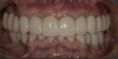 Teeth Whitening After