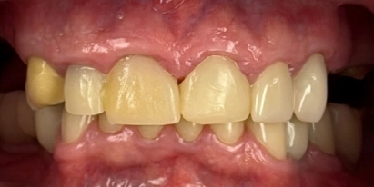 Teeth Whitening Before