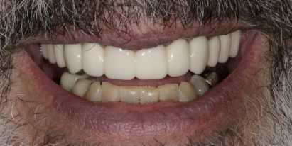 Veneers After