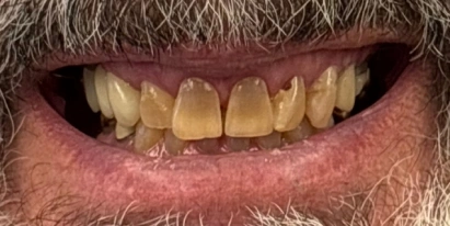 Veneers Before