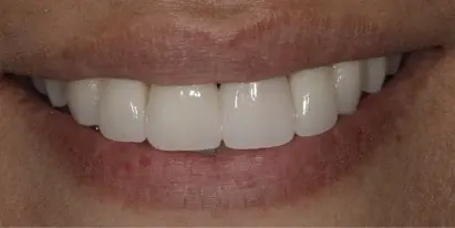 Straight white teeth smile after cosmetic dental treatment in Evergreen, CO.