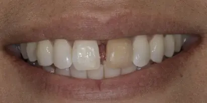 Before photo showing misaligned upper front teeth with spacing irregularities before orthodontic treatment.